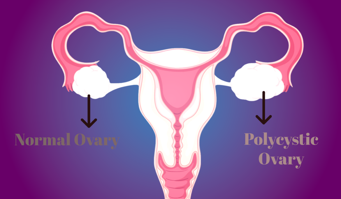 Getting Pregnant With PCOS